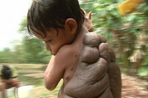 TURTLEBOY7yearoldDidierissufferingfromaconditionisknownasacongenitalmelanocyticnevusacommonskincomplaint
