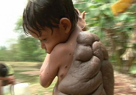 TURTLEBOY7yearoldDidierissufferingfromaconditionisknownasacongenitalmelanocyticnevusacommonskincomplaint